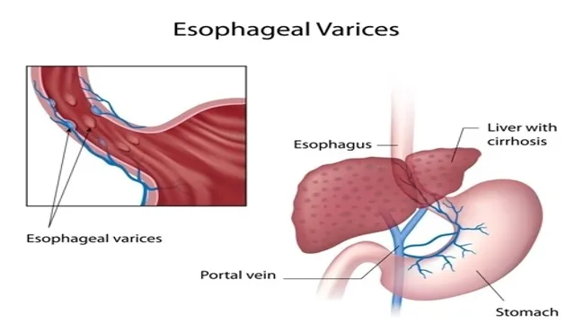 esophageal varices surveillance guideli es